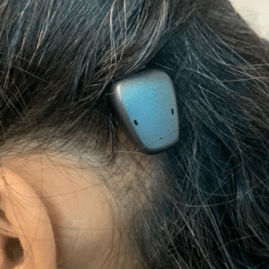 Baha- bone anchored hearing aid